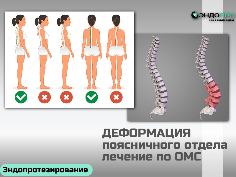 Деформация поясничного отдела позвоночника лечение по ОМС
Деформация поясничного отдела позвоночника — патология, которая может существенно снижать качество жизни из‑за боли и ограничения подвижности. Лечение всегда подбирают индивидуально: тактика зависит от типа и степени деформации, возраста пациента и сопутствующих состояний.

На ранних стадиях приоритет отдают консервативным методам. В комплекс нередко включают лечебную физкультуру — она укрепляет мышечный корсет и помогает стабилизировать отдел. Дополняют терапию физиопроцедурами, массажем и, при необходимости, медикаментозным снятием болевого синдрома. Иногда используют ортопедические корсеты — они разгружают поясницу и поддерживают правильное положение позвонков.

Если деформация прогрессирует либо консервативные меры не дают эффекта, рассматривают хирургические варианты. Это могут быть реконструктивно‑пластические вмешательства либо стабилизирующие операции — их цель состоит в коррекции искривления и предотвращении дальнейших изменений.

Важно: любую тактику должен определять врач после полноценной диагностики (рентген, МРТ и др.). Самостоятельное лечение способно усугубить проблему.