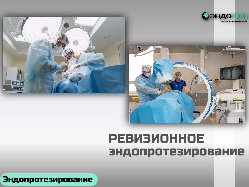 Ревизионное (повторное или реэндопротезирование) эндопротезирование суставов БЕСПЛАТНО?
Ревизионное эндопротезирование — это не «повторная установка» по той же схеме, а отдельный тип ортопедического вмешательства со своей тактикой и набором технических решений.

Ключевые отличия ревизионной операции от первичной:

Оценка состояния кости. При удалении старого импланта нередко выявляют костные дефекты и зоны остеолиза. Для планирования используют КТ и специальные шаблоны, чтобы точно определить объём потери костной ткани.
Выбор конструкции. Ревизионные протезы отличаются от стандартных: у них более длинные ножки, дополнительные упоры и элементы фиксации. В ряде случаев применяют модульные системы, которые позволяют собрать имплант прямо в операционной, точно повторяя анатомию пациента.
Восполнение дефектов. Для надёжной фиксации протеза используют костную пластику (аллотрансплантаты, металлические клинья, костный цемент). Это восстанавливает опорную функцию кости и снижает риск повторных осложнений.
Профилактика нестабильности. При выраженном дефиците связок или костной опоры применяют более связанные конструкции (hinged или constrained-системы), которые берут на себя часть стабилизирующей функции.