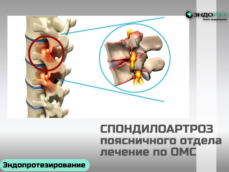 Спондилоартроз лечение по ОМС
Спондилоартроз (фасеточная артропатия) – это хроническое дегенеративно-дистрофическое заболевание межпозвонковых (фасеточных) суставов позвоночника. В основе болезни лежит износ и разрушение хрящевой ткани суставных поверхностей, что приводит к болевому синдрому, ограничению подвижности и, в запущенных случаях, к неврологическим осложнениям. Это одна из самых частых причин болей в спине, особенно у людей старше 45-50 лет, и является частным случаем остеоартроза.