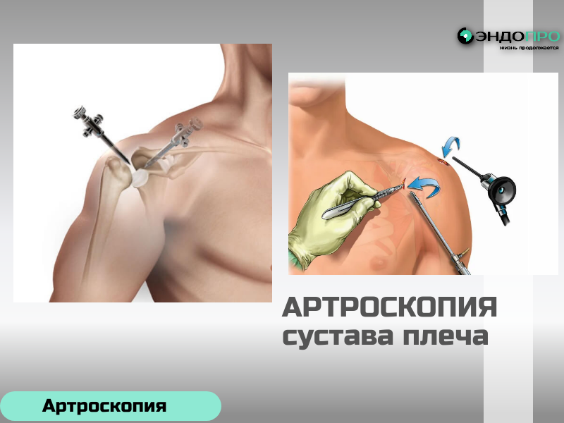 Артроскопия сустава плеча с денервацией БЕСПЛАТНО по ОМС
Артроскопия плечевого сустава с денервацией: сочетание точной диагностики и целенаправленного обезболивания
Артроскопия плечевого сустава — один из самых информативных и щадящих методов работы с патологиями этого сложного сочленения. Благодаря минимальной инвазивности и отличной визуализации внутренних структур хирург может не только детально оценить состояние хрящей, связок, капсулы и сухожилий, но и сразу выполнить необходимые лечебные манипуляции. В ряде случаев в рамках одной артроскопической сессии проводят и денервацию — целенаправленное воздействие на нервные волокна, ответственные за передачу болевых импульсов. Такой комбинированный подход позволяет одновременно устранить причину проблемы и купировать стойкий болевой синдром.