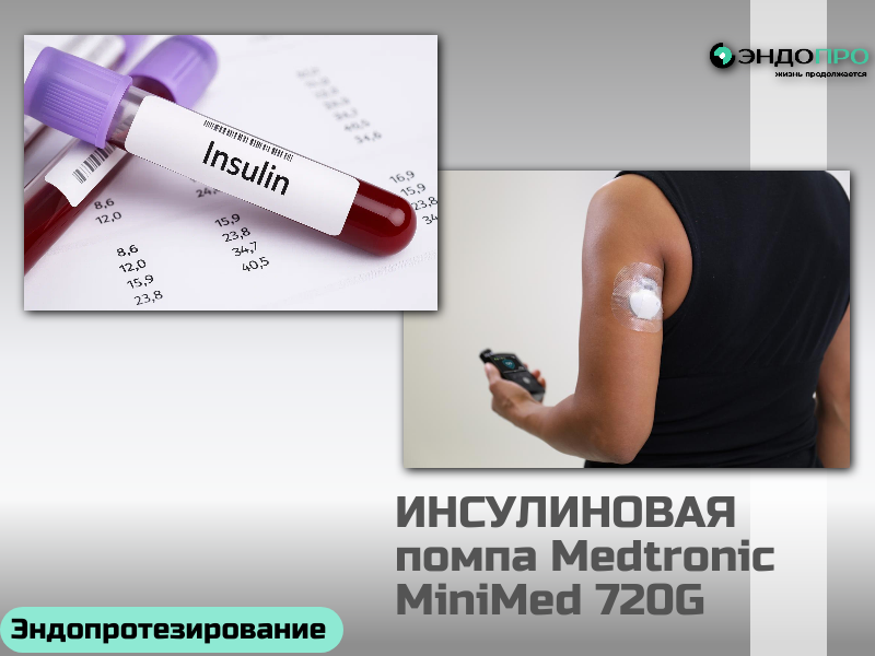 Какой инсулин используется в помпах?  Помпа + установка – БЕСПЛАТНО (ОТ 18 ЛЕТ)
В инсулиновых помпах в современной практике используют только инсулины ультракороткого действия. Чаще всего речь идёт об их аналогах — то есть молекулах, в которых немного изменена природная структура (например, поменяны местами отдельные аминокислоты). Благодаря таким модификациям эти препараты начинают работать быстрее, чем обычный человеческий инсулин короткого действия: эффект наступает раньше, пик наступает оперативнее, и само действие завершается быстрее. Именно это и делает их идеальными для помпы: устройство способно очень гибко подстраивать подачу — и в фоновом режиме (базально), и в ответ на еду (болюсно), — максимально имитируя естественную секрецию инсулина здоровой поджелудочной железой.
Почему же не используют, скажем, инсулины длительного действия? Дело в механике работы помпы. Длинные инсулины создают депо в тканях и работают плавно на протяжении многих часов. Помпе же нужна «подвижность»: она должна уметь резко менять скорость подачи в ответ на разные ситуации (физическая активность, съеденное). 