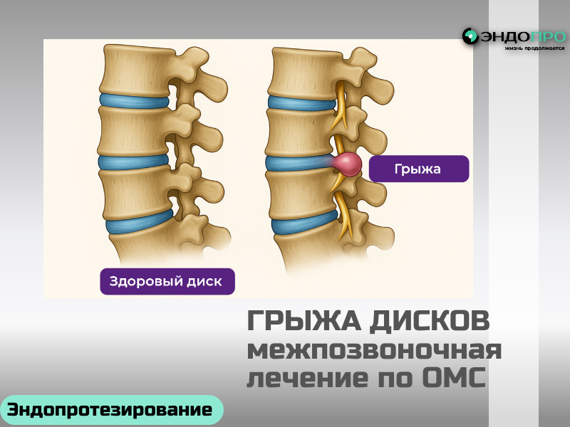 Грыжа межпозвоночного диска поясничного отдела - БЕСПЛАТНОЕ лечение для граждан РФ
Грыжа диска в поясничном отделе — одна из частых причин сильной боли в спине и ограничения подвижности. Хорошая новость в том, что граждане России могут получить полноценную медицинскую помощь при этой патологии бесплатно — в рамках программы обязательного медицинского страхования (ОМС).

Что входит в бесплатное лечение
По полису ОМС доступен полный цикл помощи — от первичной диагностики до хирургического лечения и базовой реабилитации. В программу входят:

консультации невролога, нейрохирурга, травматолога‑ортопеда;
инструментальные исследования (рентген, МРТ, КТ) для подтверждения диагноза и оценки размеров грыжи;
консервативная терапия: подбор медикаментов, физиотерапия, ЛФК по показаниям;
оперативные вмешательства при наличии строгих показаний — в том числе малоинвазивные методики (например, микродискэктомия, эндоскопическое удаление грыжи).
Такой подход позволяет подобрать оптимальную тактику: в одних случаях достаточно консервативных мер, в других — требуется операция, чтобы снять компрессию с нервных корешков и предотвратить осложнения.