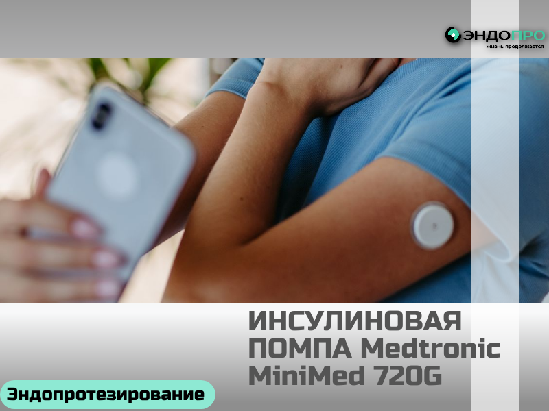 Инсулиновая помпа Medtronic MiniMed 720G по ОМС Бесплатно (ОТ 18 ЛЕТ)

Medtronic MiniMed 720G (модель MMT‑1859) — современное устройство для инсулинотерапии, призванное максимально приблизить режим подачи гормона к естественной работе поджелудочной железы. Помпа непрерывно доставляет инсулин в организм, заменяя множественные ежедневные инъекции. Она поддерживает два ключевых типа введения: базальный — для покрытия фоновых потребностей тела, и болюсный — чтобы компенсировать приёмы пищи либо скорректировать повышенный уровень глюкозы. При этом менять инфузионный набор требуется лишь каждые трое суток, что заметно упрощает повседневный контроль диабета.

Основные функциональные возможности
Гибкая базальная терапия. Устройство позволяет задать до 48 разных скоростей подачи инсулина в течение суток и использовать до 8 отдельных профилей базальной подачи — это удобно, если потребность в инсулине меняется в зависимости от режима дня, физической активности или других факторов. Диапазон скорости — от 0 до 35 ЕД/ч, а минимальный шаг регулировки составляет всего 0,025 ЕД, что даёт высокую точность дозирования.
Временная базальная скорость (ВБС). Функция полезна в ситуациях, когда на короткое время нужно скорректировать базовую подачу: например, при интенсивной тренировке или болезни. Длительность ВБС можно установить от 30 минут до 24 часов, а уровень подачи — изменить в диапазоне от 0 до 200 % от обычного значения.
Болюсный режим. Помпа поддерживает введение болюсов объёмом до 75 ЕД за один раз. Доступны два варианта скорости подачи: стандартная (1,5 ЕД/мин) и быстрая (15 ЕД/мин), что позволяет адаптировать введение под разные типы пищи и индивидуальные особенности усвоения углеводов.
Практические параметры эксплуатации
Память и отслеживание данных. Устройство хранит историю введения инсулина и другие показатели за 90 дней; при этом в активном интерфейсе удобно просматривать данные за последние 30 дней — это помогает анализировать динамику и обсуждать терапию с врачом.
Питание. Помпа работает от одной батарейки типа AA: можно использовать литиевые, щелочные либо перезаряжаемые элементы — выбор зависит от личных предпочтений и условий использования.
Габариты и вес. Компактные размеры (9,6 × 5,36 × 2,44 см) и небольшой вес (106 г без батарейки и расходников) делают устройство удобным для постоянного ношения.
Температурный режим. Корректная работа помпы гарантирована в диапазоне от +5 °C до +40 °C — это важно учитывать при хранении и эксплуатации, особенно в поездках или в условиях резких перепадов температур.
Доступность по ОМС