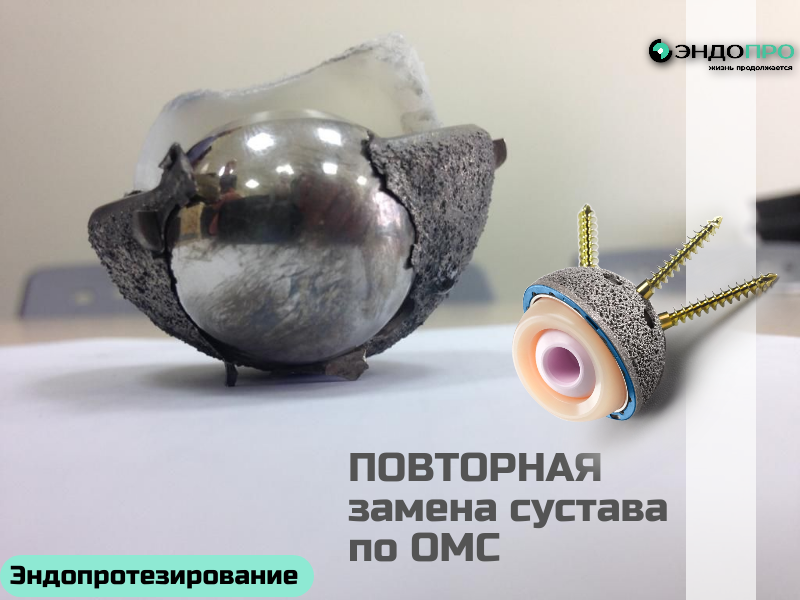 Ревизионное эндопротезирование: можно ли сделать повторную замену сустава бесплатно?