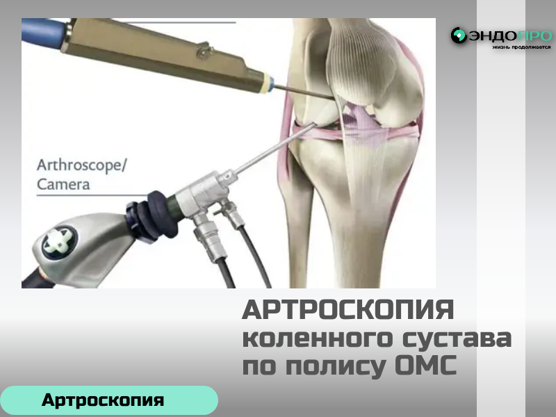 Артроскопия коленного сустава для граждан РФ проводится бесплатно по полису ОМС при наличии медицинских показаний.
Это малоинвазивное вмешательство, которое используют и для точной диагностики, и для лечения внутрисуставных патологий.
Что входит в объём помощи по ОМС:
консультация травматолога‑ортопеда;
необходимые обследования для подтверждения показаний (в том числе МРТ, рентген, лабораторные анализы по назначению врача);
сама артроскопическая операция;
анестезия (вид определяет врач с учётом состояния пациента и объёма вмешательства);
пребывание в стационаре, питание и медикаменты;
наблюдение в раннем послеоперационном периоде и базовые рекомендации по реабилитации.
Как получить направление:
Записаться к терапевту или сразу к травматологу‑ортопеду в поликлинике по месту прикрепления.
Пройти назначенные обследования и подтвердить диагноз.
Получить направление по форме 057/у‑04.
Собрать документы: паспорт, полис ОМС, СНИЛС, результаты исследований и выписку из амбулаторной карты.
Передать пакет в профильную медорганизацию (часто это делает поликлиника, но можно подать и самостоятельно).
Дождаться решения комиссии и даты госпитализации.
Срок ожидания зависит от региона, загруженности отделения и срочности случая. При острых состояниях (например, блокаде сустава) помощь оказывают в приоритетном порядке.