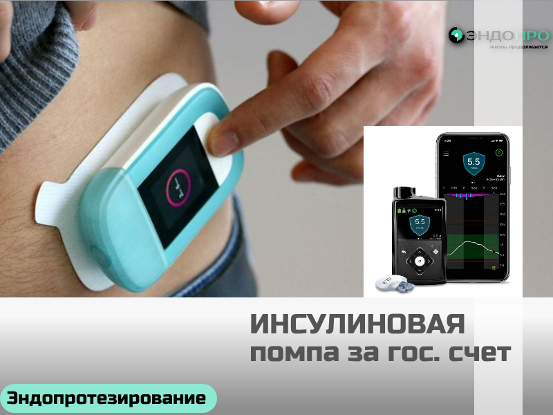 Инсулиновая помпа за государственный счёт: как получить по программе госгарантий БЕСПЛАТНО (ОТ 18 ЛЕТ)