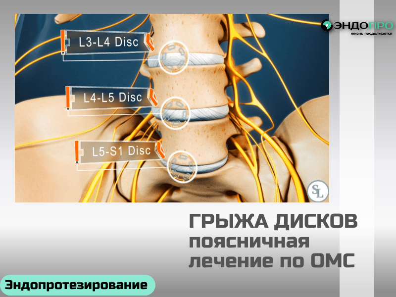 Грыжа межпозвоночного диска поясничного отдела: бесплатное лечение для граждан РФ по ОМС
Граждане России могут пройти диагностику и лечение грыжи межпозвоночного диска поясничного отдела полностью бесплатно — в рамках программы ОМС. Тактика (консервативная или хирургическая) определяется врачом строго по показаниям и клиническим рекомендациям.
Что покрывает ОМС:
консультации профильных специалистов (невролог, нейрохирург, травматолог‑ортопед);
инструментальную диагностику: рентген, МРТ пояснично‑крестцового отдела (по показаниям), ЭНМГ и иные исследования, предусмотренные стандартами;
медикаментозную терапию в рамках перечней ЖНВЛП (противовоспалительные, миорелаксанты, витамины группы B и др.);
физиотерапию, ЛФК, массаж (при отсутствии противопоказаний);
лечебно‑диагностические блокады (эпидуральные, паравертебральные) при выраженном болевом синдроме;
хирургическое лечение (в том числе как ВМП): микродискэктомия, эндоскопические операции и другие методики по решению врачебной комиссии;
пребывание в стационаре, анестезию, питание, медикаменты и расходные материалы;
послеоперационное наблюдение и базовые рекомендации по реабилитации.
Пошаговый алгоритм получения помощи:

Записаться к терапевту или неврологу в поликлинике по месту прикрепления.
Пройти назначенные обследования (ключевое — МРТ пояснично‑крестцового отдела; рентген используют как скрининг).
Получить консультации узких специалистов (нейрохирург/травматолог‑ортопед) для определения тактики.
Собрать документы: паспорт, полис ОМС, СНИЛС, результаты исследований, выписку из амбулаторной карты.
Получить направление по форме 057/у‑04 от лечащего врача.
Передать документы в профильную клинику (через поликлинику или самостоятельно) и дождаться вызова на госпитализацию либо плана амбулаторного лечения.