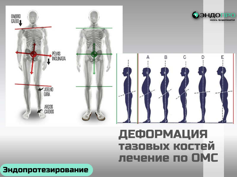 Деформация таза: лечение по ОМС для граждан России
Деформация таза — это нарушение его нормальной анатомии. Она может возникать по разным причинам: из-за перенесённых травм, врождённых особенностей, последствий заболеваний или длительно текущих проблем (например, выраженного сколиоза). Такое состояние способно влиять на осанку, походку, а в некоторых случаях — и на работу внутренних органов. Хорошая новость: в России часть помощи при такой патологии можно получить бесплатно — по полису ОМС. Но важно понимать: объём поддержки зависит от причины и степени деформации. 
Если деформация выраженная и существенно нарушает функции организма, врач может рекомендовать операцию. По ОМС проводят разные виды вмешательств — например, остеотомию (искусственное пересечение кости для коррекции положения) или другие реконструктивные операции. В отдельных случаях речь идёт о высокотехнологичной медицинской помощи (ВМП): например, о сложных реконструктивно-пластических операциях с использованием специальных фиксирующих устройств, остеозамещающих материалов или компьютерной навигации. Решение о ВМП принимает врачебная комиссия при наличии чётких показаний. 
ok.ru +3
Как организовать получение помощи?
Обратитесь к профильному специалисту. Запишитесь к травматологу-ортопеду в поликлинику по месту прикрепления. 
Пройдите обследование. Врач назначит исследования (рентген, КТ или МРТ), чтобы точно оценить состояние костных структур. 
Получите помощь в стационаре или специализированном центре. При показаниях вас направят в больницу, где есть нужные специалисты и оборудование. 
Несколько важных моментов:
Право на помощь по ОМС есть у всех граждан России, независимо от региона проживания. 
Не все виды деформаций одинаково часто покрываются: врач и комиссия оценивают медицинские показания, а не только сам факт диагноза. 
Если вам кажется, что ваши права нарушают (например, отказывают в нужном обследовании или операции при явных показаниях), можно обратиться в страховую компанию или в территориальный фонд ОМС