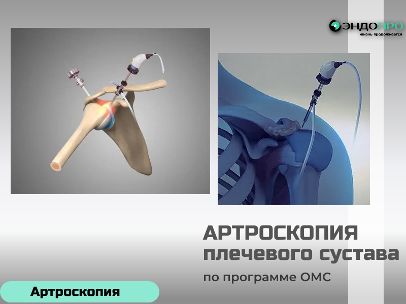 Как проводят артроскопию плечевого сустава: этапы процедуры? 