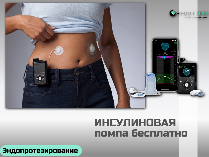 можно ли получить инсулиновую помпу без финансовых затрат? БЕСПЛАТНО (ОТ 18 ЛЕТ)
Суть возможности. Установить инсулиновую помпу за счёт средств ОМС действительно можно. Дело в том, что такое лечение относят к высокотехнологичной медицинской помощи (ВМП), которая включена в базовую программу ОМС. То есть сам аппарат, его установка и обучение управлению системой для пациента бесплатны. 

Кому это положено. Решение принимает лечащий врач-эндокринолог. Обычно показания возникают, когда стандартная схема инъекций перестаёт эффективно контролировать диабет. Часто это пациенты с сахарным диабетом 1 типа, которым требуется несколько инъекций в сутки, но также помпу могут рассмотреть и при некоторых формах диабета 2 типа, если есть особые клинические показания. Врач оценит ситуацию: как протекает болезнь, какие есть осложнения, насколько пациент мотивирован и владеет навыками самоконтроля

Несколько практических моментов.
Установить помпу по ОМС можно не только в государственной, но и в частной клинике, если она работает в системе ОМС. 
Пациенты из регионов могут воспользоваться программой и поехать на установку в другой субъект — например, в Москву (в рамках проекта «Москва — столица здоровья»). 
После установки важно продолжать наблюдение у эндокринолога: врач будет корректировать настройки помпы и следить за 