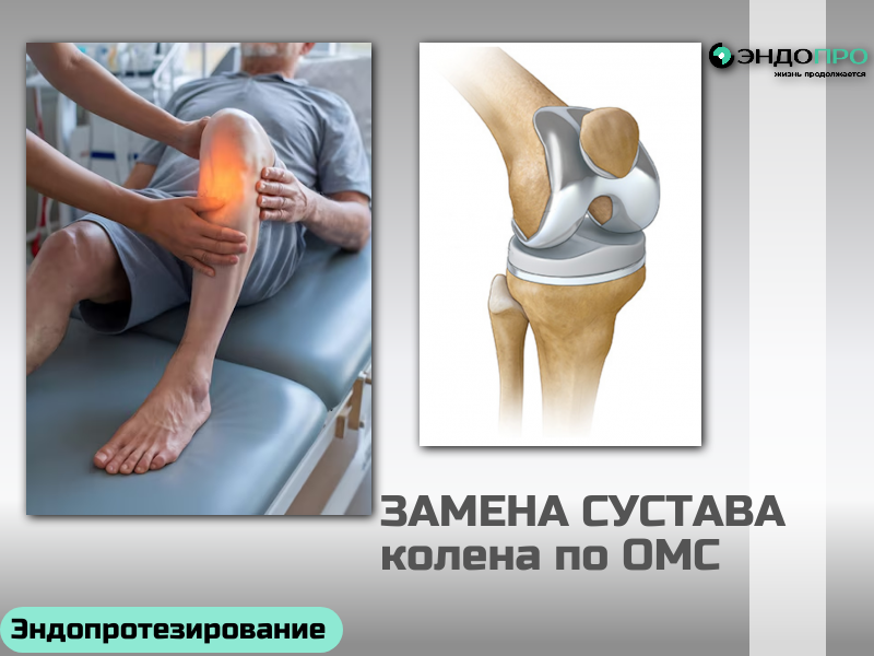 Как жить с протезом коленного сустава: практические рекомендации и особенности адаптации
Эндопротезирование коленного сустава возвращает человеку подвижность и избавляет от хронической боли — но чтобы результат операции сохранился надолго, важно грамотно выстроить жизнь после вмешательства. Успех во многом зависит не только от мастерства хирурга, но и от того, насколько последовательно пациент соблюдает рекомендации врачей в долгосрочной перспективе.
Первые недели: безопасность и постепенная активация
Сразу после операции начинается самый ответственный этап: организм восстанавливается, а новый сустав «привыкает» к нагрузкам. В этот период ключевое значение имеют:
Контроль за состоянием раны. До снятия швов нельзя мочить область разреза, а любые признаки воспаления (покраснение, отёк, выделения, повышение температуры) — повод срочно обратиться к лечащему врачу.
Профилактика тромбозов. Обычно назначают антикоагулянты и компрессионные чулки — их нужно носить ровно столько, сколько прописал врач.
Правильная активизация. Первые движения делают под контролем медперсонала: учат вставать, ходить с опорой (костыли, ходунки), подниматься и спускаться по лестнице. Правило простое: на подъём первой идёт здоровая нога, на спуск — сначала опора и оперированная нога, потом здоровая.
