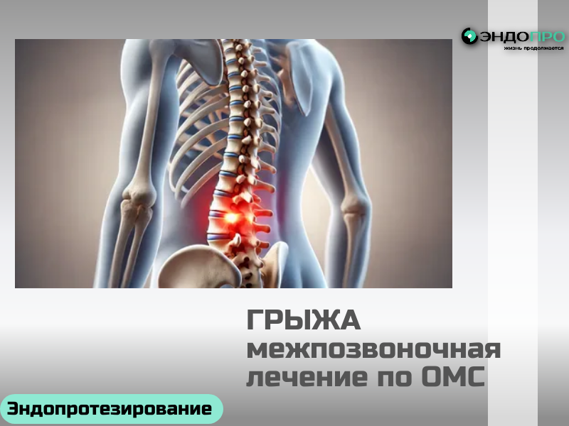 Подходы к лечению межпозвонковой грыжи: от тактики до хирургических решений, бесплатное лечение для граждан РФ по ОМС
Вариант 1: удаление грыжевого выпячивания
Наиболее распространённый подход — микродискэктомия, то есть удаление непосредственно грыжи. Операция позволяет быстро устранить компрессию нервного корешка и купировать болевой синдром. Однако важно понимать: сама причина формирования грыжи (например, дегенеративные изменения диска, нарушение биомеханики сегмента) при этом не устраняется. Поэтому даже после успешного вмешательства сохраняется риск рецидива или прогрессирования изменений на этом или соседнем уровне.

Вариант 2: декомпрессивно‑стабилизирующие операции
Если грыжевое выпячивание достаточно объёмное, его удаление может существенно изменить биомеханику сегмента: нагрузка перераспределяется, амортизирующая функция диска снижается, что создаёт предпосылки для перегрузки соседних позвонков. В таких случаях одного удаления грыжи недостаточно — требуется стабилизация. Для этого применяют специальные конструкции (транспедикулярные фиксаторы, кейджи и др.), которые берут на себя часть амортизационной нагрузки и обеспечивают стабильность оперированного сегмента. Такой подход снижает риск вторичных деформаций и перегрузки смежных уровней, но требует более сложного вмешательства и тщательного планирования.

Вариант 3: замена межпозвонкового диска имплантом
В запущенных случаях, когда диск практически полностью утратил свою функцию (выраженный дегенеративный процесс, коллапс высоты диска), может потребоваться его полное удаление с последующей заменой на искусственный имплант. Это высокотехнологичное вмешательство, направленное на сохранение подвижности сегмента либо на надёжную стабилизацию в зависимости от типа конструкции. Операция отличается высокой стоимостью, а реабилитация занимает продолжительное время: пациенту требуется поэтапное восстановление двигательного режима, ЛФК под контролем специалиста и регулярный контроль состояния оперированно