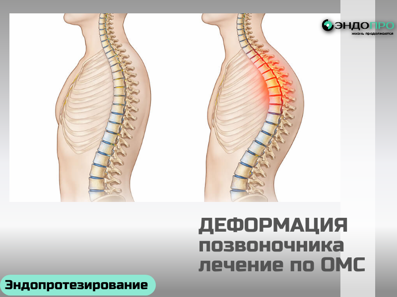 Лечение деформации позвоночника по ОМС: возможности, этапы и важные нюансы
Какие деформации лечат по ОМС
В рамках программы госгарантий помощь оказывают при разных видах деформац