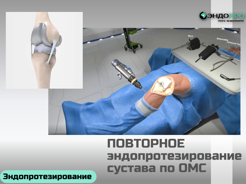 Повторное (ревизионное) эндопротезирование сустава: особенности, показания и подход к лечению — бесплатно по программе ОМС
Ревизионное эндопротезирование — это хирургическая замена ранее установленного искусственного сустава или его отдельных компонентов. В отличие от первичной операции, ревизия решает более сложные клинические задачи: устраняет последствия износа, нестабильности или осложнений, восстанавливая функцию конечности и качество жизни пациента. Учитывая ваш интерес к рискам и особенностям ортопедических вмешательств, разберём ключевые аспекты этой операции максимально предметно.
Когда требуется повторная замена
Необходимость ревизионного вмешательства возникает, если первичный эндопротез перестаёт выполнять свою функцию. Основные причины:
Асептическая нестабильность. Со временем компоненты протеза теряют прочную фиксацию в кости из‑за микродвижений и реакции тканей на микрочастицы износа. Это приводит к боли при нагрузке и прогрессирующему разрушению окружающей костной ткани.
Износ вкладыша. Полиэтиленовые элементы истираются, а образующиеся микрочастицы запускают воспалительную реакцию, которая способствует остеолизу — постепенному 