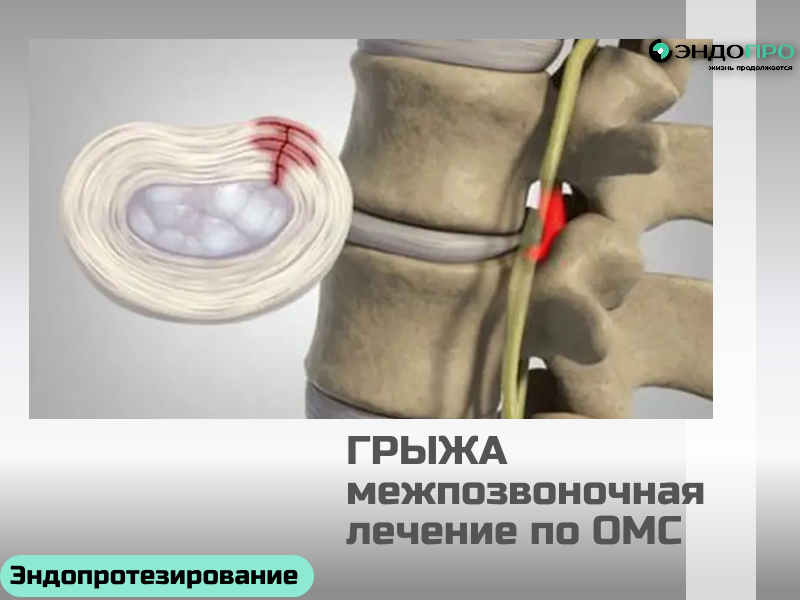 Межпозвоночная грыжа: как пройти лечение по ОМС для граждан РФ
Межпозвоночная грыжа — одно из самых частых состояний, при которых пациенты сталкиваются с выраженной болью и ограничением подвижности. Хорошая новость: в России лечение этого заболевания доступно бесплатно по полису ОМС — от диагностики и консервативной терапии до высокотехнологичных операций. Учитывая ваш интерес к медицинским текстам и организации помощи (в том числе по ОМС), разберём, какие варианты реально доступны, как их получить и на что рассчитывать.
Что покрывается по ОМС
Программа госгарантий включает полный цикл помощи при грыже:
Консультации профильных специалистов (невролог, нейрохирург, 