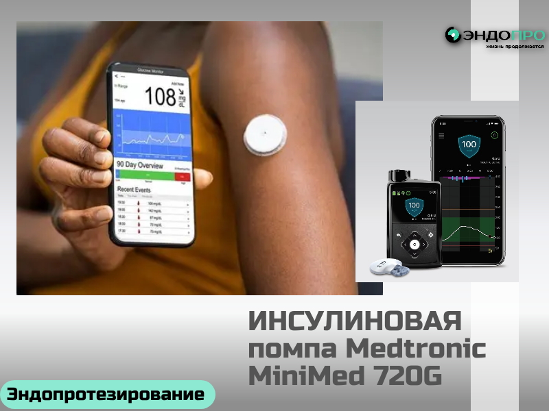 Инсулиновая помпа при сахарном диабете: ключевые преимущества (по ОМС для граждан России от 18 лет)