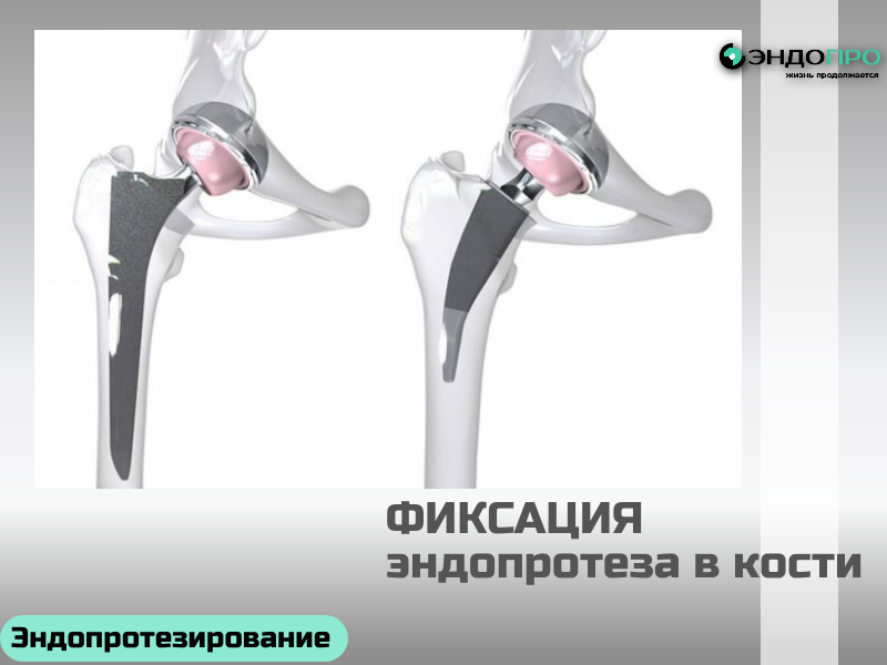 Фиксация эндопротеза в кости: надёжность и долгосрочная стабильность
Надёжная фиксация эндопротеза — ключевое условие успешной эндопротезирования: от неё зависят первичная стабильность конструкции, скорость остеоинтеграции и срок службы имплантата. Современные подходы позволяют подбирать оптимальный тип фиксации с учётом состояния костной ткани, возраста пациента и функциональной нагрузки.
Основные типы фиксации
Цементная. Используется костный цемент на основе полиметилметакрилата (PMMA): он равномерно распределяет нагрузку, заполняет микронеровности кости и обеспечивает мгновенную стабильность. Такой метод особенно актуален у пациентов с остеопорозом или сниженной плотностью кости.
Бесцементная. Эндопротез имеет пористую, шероховатую или гидроксиапатитовое покрытие: кость прорастает в структуру имплантата, формируя прочную биологическую фиксацию. Этот вариант чаще выбирают для более молодых и активных пациентов с хорошим качеством костной ткани.
Комбинированная. Сочетает цементную фиксацию одной 
