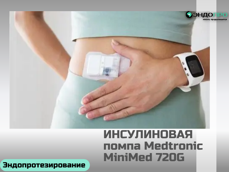 Безопасна ли инсулиновая помпа? БЕСПЛАТНО (ОТ 18 ЛЕТ)
Безопасность здесь во многом зависит от вас. Современные помпы оснащены системами самодиагностики и подают сигналы при неполадках (например, если в системе выросло давление). Однако если игнорировать правила — не следить за самоконтролем, долго не менять инфузионную систему, не обращать внимания на сигналы устройства, — риски возрастают. Среди возможных сложностей: нарушение подачи инсулина (из-за загиба канюли, воздуха в системе, неисправности), что при помповой терапии (где обычно используется только короткий инсулин) может довольно быстро привести к повышению глюкозы и кетоацидозу; местные реакции в месте установки катетера (воспаление, аллергия на пластырь или материал 