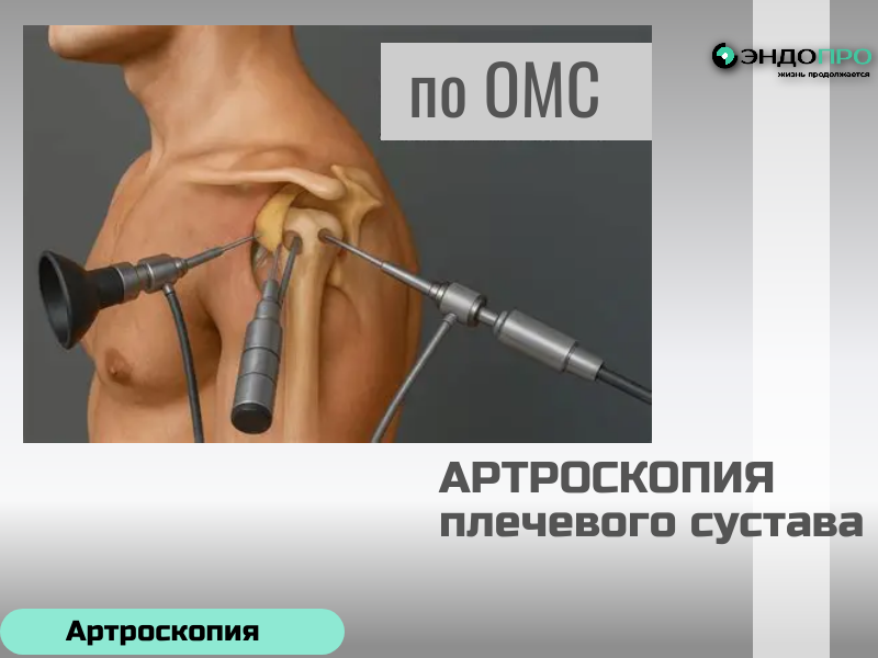 Артроскопия плечевого сустава: ключевые особенности (бесплатно по полису ОМС)
Артроскопия плечевого сустава — малоинвазивный метод, который одновременно решает диагностические и лечебные задачи: через небольшие проколы (3–5 мм) хирург 