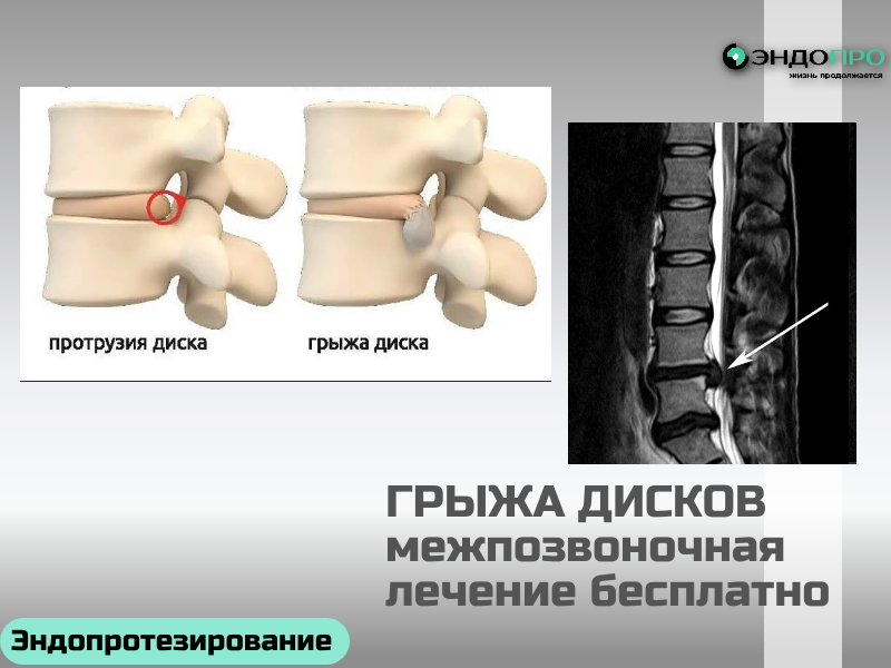 Чем опасна межпозвонковая грыжа? (бесплатное лечение для граждан РФ по ОМС)
Основные механизмы опасности
Сдавление спинномозговых корешков. Это самая частая причина боли, онемения и слабости в конечностях. Длительное давление приводит к отёку нерва, нарушению его питания и проводимости — в итоге развивается стойкий неврологический дефицит.
Компрессия спинного мозга. В шейном и грудном отделах пространство в позвоночном канале ограничено, поэтому даже умеренно выраженная грыжа может сдавливать само вещество спинного мозга. Это потенциально опасная ситуация, способная привести к парезам, нарушениям чувствительности и тазовым расстройствам.
Нарушение кровоснабжения нервных структур. Грыжевое выпячивание может сдавить сосуды, питающие нервные корешки или сегменты спинного мозга, что усугубляет ишемические изменения и ускоряет развитие неврологических симптомов.
Секвестрация. Фрагмент 
