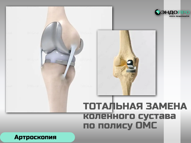 Тотальная замена коленного сустава: восстановление подвижности и качества жизни по полису ОМС
Тотальное эндопротезирование коленного сустава — эффективное хирургическое решение при выраженном разрушении суставных поверхностей, когда консервативная терапия уже не помогает. В ходе операции заменяют повреждённые участки бедренной и большеберцовой костей, а при необходимости — и надколенник: на их место устанавливают компоненты эндопротеза из высокопрочных биосовместимых материалов (титановых сплавов, кобальт‑хромовых композиций, полиэтилена высокой плотности).
Главная цель вмешательства — устранить стойкий болевой синдром, восстановить опорную функцию конечности и объём движений, а также скорректировать деформацию оси ноги. Чаще всего к тотальной замене прибегают при тяжёлых формах гонартроза, ревматоидном артрите, посттравматическом артрозе и значительных деформациях сустава.
Ключевым фактором успеха служит точная установка компонентов протеза: современные подходы включают использование навигационных систем и роботизированной поддержки, которые помогают добиться правильного позиционирования и равномерного распределения нагрузки. Не менее важна и грамотно выстроенная реабилитация: ранние дозированные нагрузки, ЛФК и физиотерапия ускоряют 