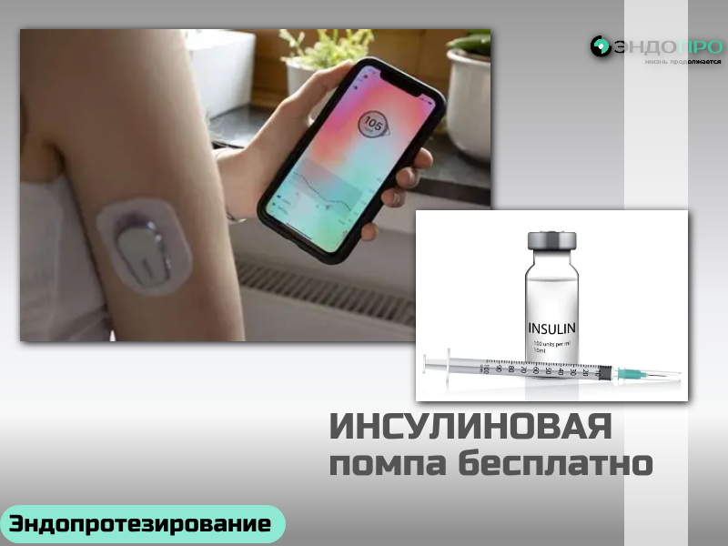 Инсулиновая помпа Medtronic MiniMed 720G: умный контроль гликемии (по ОМС Бесплатно от 18 лет)
Medtronic MiniMed 720G — это не просто устройство для подачи инсулина, а полноценная система поддержки терапии при сахарном диабете, сочетающая точную доставку инсулина с интеллектуальным прогнозированием уровня глюкозы. Помпа помогает пациенту удерживать сахар в целевом диапазоне, снижая риск резких колебаний и уменьшая ежедневную нагрузку по контролю диабета. Учитывая ваш интерес к медицинским текстам про инсулиновые помпы, этот материал раскрывает как технические возможности, так и практическую пользу для пациента и врача.
Как работает система
MiniMed 720G обеспечивает непрерывную подкожную инфузию ультракороткого инсулина через инфузионный набор — это заменяет многократные ежедневные инъекции. Подача инсулина идёт в двух базовых режимах:
Базальный режим. Инсулин вводится малыми дозами круглосуточно, покрывая фоновую потребность организма. В помпе можно задать до 8 разных базальных профилей и до 48 базальных скоростей в сутки — это удобно при сменной работе, частых перелётах или индивидуальных суточных колебаниях потребности в инсулине.
Болюсный режим. Пациент самостоятельно активирует подачу инсулина для компенсации углеводов в пище или для коррекции повышенного сахара. Максимальный болюс — до 75 Ед за один раз, а минимальный шаг подачи составляет всего 0,025 Ед, что важно для тонкой настройки, особенно у детей и чувствительных пациентов.