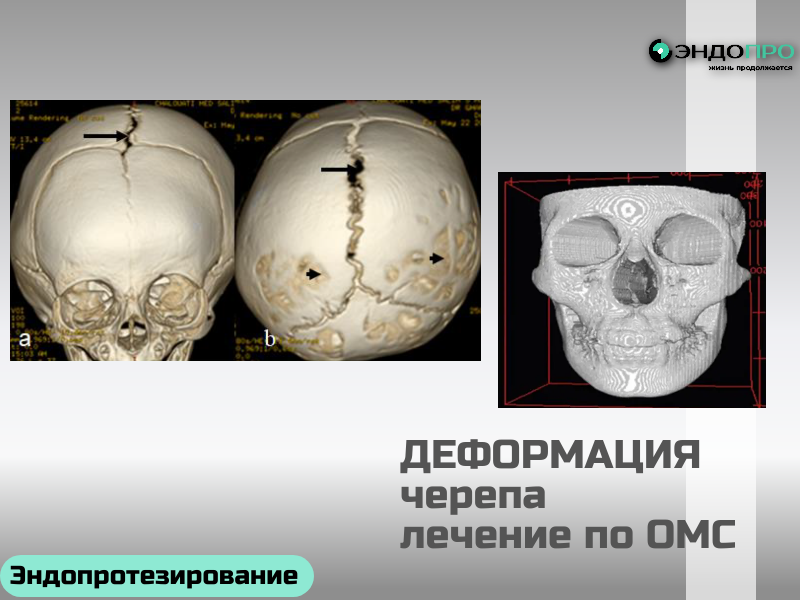 Лечение деформации черепа по ОМС: доступ к высокотехнологичной помощи
Деформация черепа — не просто эстетическая проблема: в ряде случаев она напрямую влияет на развитие головного мозга, уровень внутричерепного давления и неврологический статус пациента. В России лечение таких состояний доступно бесплатно по полису ОМС — в том числе сложные нейрохирургические вмешательства в рамках программы высокотехнологичной медицинской помощи (ВМП). Учитывая ваш интерес к медицинским услугам по ОМС и хирургическим протоколам, разберём, какие варианты лечения реально получить, как строится путь пациента и на что важно обратить внимание.