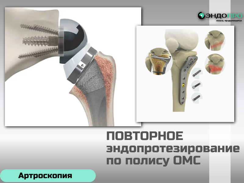 Повторное эндопротезирование по полису ОМС: доступность и порядок получения помощи 
Ревизионное (повторное) эндопротезирование — сложная операция по замене ранее установленного эндопротеза или его компонентов. В России такое вмешательство доступно гражданам бесплатно в рамках программы ОМС, зачастую как вид высокотехнологичной медицинской помощи (ВМП).
По ОМС покрывается полный цикл: консультации профильных специалистов, необходимые обследования (рентген, КТ, МРТ, лабораторные анализы), сама операция, расходные материалы и ревизионные компоненты протеза, анестезия, пребывание в стационаре, питание, медикаменты, а также базовое послеоперационное наблюдение.
Показаниями к ревизии чаще всего становятся износ или расшатывание компонентов, инфекционные осложнения в зоне протеза, вывих, перелом конструкции либо выраженный болевой синдром и нарушение функции сустава.
Чтобы получить помощь, нужно:
обратиться к травматологу‑ортопеду в поликлинике по месту прикрепления;
пройти обследование и подтвердить необходимость ревизии;
собрать пакет документов (паспорт, полис ОМС, СНИЛС, выписку после первичной 