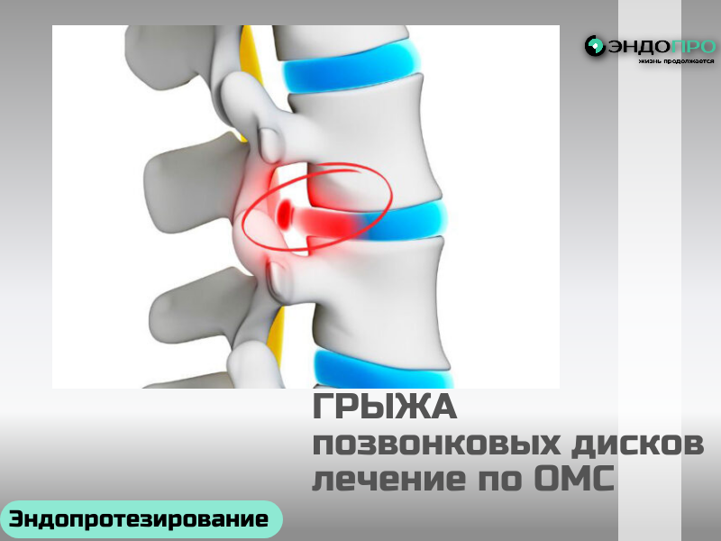 Грыжа позвонковых дисков лечение по ОМС для граждан РФ
Грыжа межпозвонкового диска: когда амортизатор даёт сбой

Межпозвонковый диск работает как амортизатор между позвонками — он гасит нагрузки и сохраняет подвижность позвоночника. При чрезмерных нагрузках, травмах или возрастных изменениях фиброзное кольцо диска истончается, в нём появляются микротрещины, и мягкое пульпозное ядро начинает выпячиваться наружу. Так формируется грыжа.

Чаще всего проблема возникает в поясничном отделе — именно он принимает на себя максимальную нагрузку. Грыжа может сдавливать нервные корешки, провоцируя боль, онемение и снижение подвижности.

Важно: любые подозрения на грыжу — повод обратиться к врачу. Точный диагноз ставят с помощью МРТ, а тактику лечения подбирают индивидуально.