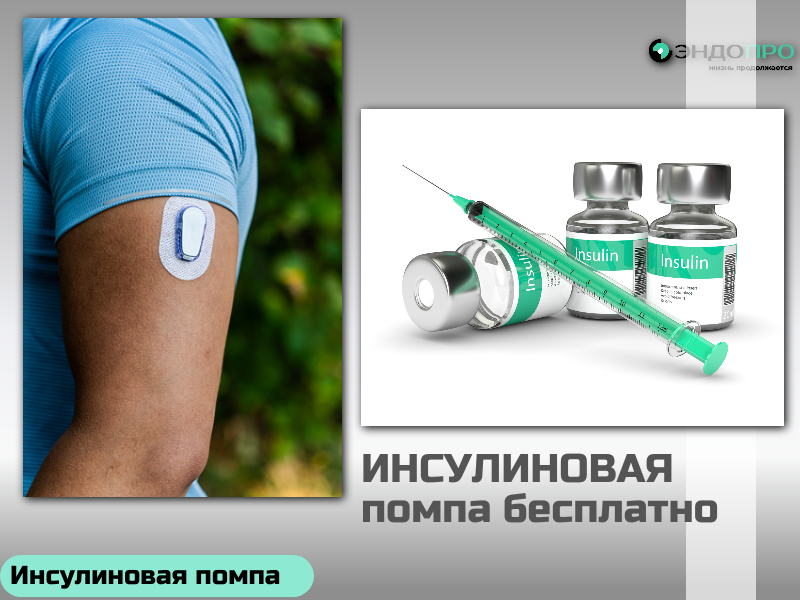 Какую инсулиновую помпу устанавливают по ОМС при сахарном диабете? по ОМС для граждан России от 18 лет)
При сахарном диабете по полису ОМС действительно устанавливают инсулиновые помпы — но важно сразу уточнить: государство не закрепляет какую-то одну единственную модель. Выбор зависит от показаний, решения врачебной комиссии и того, какие устройства закуплены в регионе или в клинике. На практике чаще всего пациентам предлагают несколько вариантов. Я подобрала основные, чтобы было проще ориентироваться. 
Medtronic MiniMed 720G (артикул MMT-1859). Один из самых распространённых вариантов. Это устройство не просто подаёт инсулин, но и умеет работать в связке с системой непрерывного мониторинга глюкозы (НМГ): оно показывает уровень сахара в реальном времени и заранее предупреждает (за 30 минут) о риске гипо- или гипергликемии. В помпе гибко настраиваются базальные профили (до 8 штук, до 48 скоростей в сутки), есть точный шаг дозирования (0,025 Ед), функция временной базальной скорости и болюсный режим. Для работы расширенных функций (полноценный НМГ) отдельно подключают трансмиттер Guardian Link 3 и сенсор Guardian Sensor 3 — сами по себе они в базовый комплект по ОМС могут не входить, это стоит уточнить у врача.