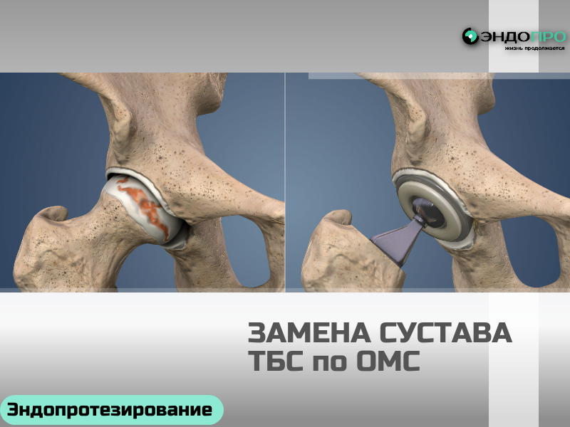 Замена тазобедренного сустава по программе ОМС. Чем отличается КВОТА от программы ОМС?
Программа ОМС — это база. Она гарантирует каждому застрахованному гражданину определённый объём медицинской помощи: приём врачей, диагностику, стандартное лечение, реабилитацию, многие виды хирургических вмешательств. То есть это «стандартная корзина» услуг, за которую платит система обязательного медицинского страхования. 

Квота — это особый механизм, который позволяет бесплатно получить то, что выходит за рамки этой стандартной корзины. Обычно речь идёт о высокотехнологичной медицинской помощи (ВМП): сложных, ресурсоёмких, уникальных или новых методах лечения. Например, операции на открытом сердце, нейрохирургические вмешательства, трансплантация органов, эндопротезирование сложных суставов, лечение с применением клеточных или роботизированных технологий. Государство выделяет на такие случаи отдельное финансирование (из федерального бюджета или специальных фондов), и квота — это, по сути, талон-направление, который даёт право на такое лечение. 
В чём ключевые отличия?
Масштаб. ОМС покрывает широкий спектр рутинной и специализированной помощи. Квота — инструмент для особо сложных и дорогих случаев. 
Процедура. Чтобы получить помощь по ОМС, обычно достаточно направления от врача. А для квоты нужен более сложный маршрут: 