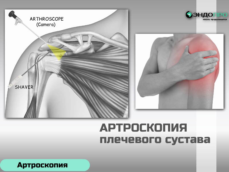 Артроскопия плечевого сустава в каких случаях нужна операция? (бесплатно по полису ОМС)
Артроскопия плечевого сустава — это малоинвазивный метод: хирург вводит в полость сустава артроскоп (миниатюрную камеру) и специальные инструменты через небольшие проколы. Такую операцию назначают не «просто так», а когда есть конкретная проблема, которую сложно решить консервативно (лекарствами, физиотерапией, ЛФК), либо когда нужно точно установить диагноз. Я подобрала основные ситуации, когда врач может предложить артроскопию. 

Повреждение ротаторной (вращательной) манжеты. Это частая причина, особенно у спортсменов или людей, чья работа связана с повторяющимися движениями руки над головой. Речь о разрывах или дегенеративных изменениях сухожилий, которые стабилизируют сустав и отвечают за вращение. В ходе артроскопии хирург может ушить разрыв или зафиксировать сухожилие к кости с помощью специальных якорных фиксаторов. 
Дегенеративные изменения (артроз). Артроскопия позволяет провести санацию: удалить повреждённые фрагменты хряща, остеофиты, свободные хрящевые или костные отломки («свободные тела»), которые нарушают биомеханику сустава и вызывают боль. 
Воспалительные и другие специфические патологии. Например, синовит (воспаление синовиальной оболочки), кальцифицирующий тендинит (отложение солей в сухожилии), адгезивный капсулит («замороженное плечо», когда капсула сустава рубцуется и резко ограничивает подвижность). В сложных случаях артроскопия нужна, чтобы точно визуализировать очаг воспаления и провести целенаправленное 