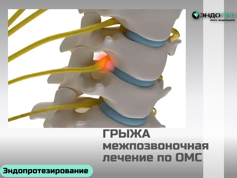 Как лечат межпозвоночную грыжу? (бесплатное лечение для граждан РФ по ОМС)
Лечат межпозвоночную грыжу по-разному — тактика зависит от стадии, симптомов и рисков. Я подобрала краткий обзор основных подходов. 

Чаще всего начинают с консервативной терапии. Врач подбирает комплекс: обезболивающие и противовоспалительные препараты, при мышечном спазме — миорелаксанты. При сильной боли могут сделать лечебную блокаду. Дополняют лечение физиотерапией (магнитотерапия, лазер), а после стихания острого воспаления — ЛФК (упражнения укрепляют мышечный корсет и снимают нагрузку с диска). Также важно скорректировать образ жизни: снизить нагрузку на позвоночник, подобрать ортопедический матрас, избегать резких движений. 
К хирургическому лечению прибегают, если консервативные методы не дали результата за несколько недель, либо есть серьёзные осложнения: нарастающая слабость в конечностях, онемение, нарушение функций тазовых органов, крупная или секвестрированная грыжа. Современные методы малоинвазивны: эндоскопическое удаление (через прокол под видеоконтролем), микродискэктомия (с микроскопом через небольшой разрез), а также лазерную вапоризацию или нуклеопластику (для уменьшения выпячивания). В сложных случаях (при нестабильности сегмента) операцию дополняют стабилизацией — установкой имплантов.