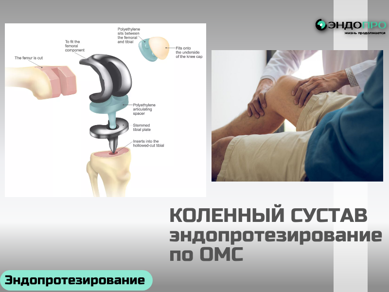 Коленный сустав - эндопротезирование по ОМС для граждан РФ, кто может воспользоваться?
Эндопротезирование коленного сустава по ОМС доступно всем гражданам РФ при наличии медицинских показаний. Я коротко собрала главное: чтобы воспользоваться этой возможностью, нужно, чтобы врач подтвердил серьёзную проблему — например, артроз 3–4-й степени, тяжёлую посттравматическую деформацию или износ ранее установленного протеза (ревизионное эндопротезирование). Решение принимает не один доктор: лечащий врач вместе с врачебной комиссией оценивает ситуацию, и если показания есть — оформляют направление (форма 057/у). В пакет документов также войдут паспорт, полис ОМС, СНИЛС и результаты обследований (рентген, МРТ, КТ). 

Важное уточнение: сама операция, современный протез, пребывание в стационаре и базовая реабилитация покрываются полисом. При этом некоторые дополнительные исследования или услуги могут не входить в программу — этот момент стоит уточнить заранее. Ещё один плюс: вы не привязаны к региону прописки — можно получить помощь в клинике другого субъекта РФ. 