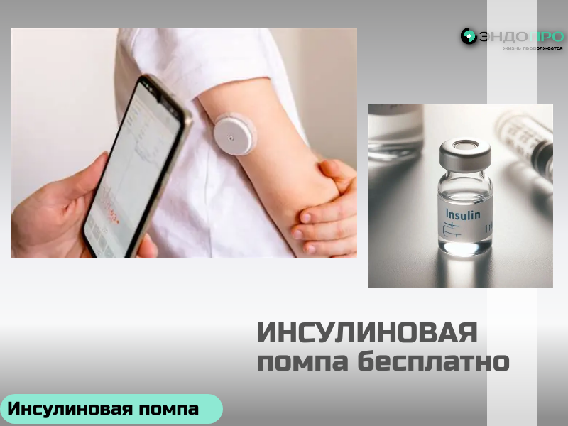 Инсулиновая помпа Medtronic MiniMed 720G: умный контроль гликемии (по ОМС Бесплатно от 18 лет)
Сама установка инсулиновой помпы обычно не вызывает сильной боли. Процедура сводится к тому, что под кожу вводят тонкую канюлю (трубочку), к которой потом подключается сам прибор. Большинство людей описывают ощущения скорее как лёгкий дискомфорт или кратковременное покалывание — примерно как при обычной подкожной инъекции. 
Но есть нюансы, из-за которых боль или неприятные ощущения всё же могут появиться:
Неподходящий размер канюли или ошибка при установке. Если канюля слишком длинная или её ввели резко, это повышает риск дискомфорта. 
Жёсткая канюля. Стальные катетеры менее травматичны в плане загиба, но из-за своей жёсткости могут ощущаться сильнее, чем мягкие пластиковые. 
Резкие движения. Если во время установки или сразу после неё сделать резкое движение (особенно в зоне, где подкожно-жировая клетчатка смещается, например на животе), это тоже может усилить неприятные ощущения. 
Уже имеющиеся проблемы в месте установки. Если в зоне, куда планируют поставить канюлю, есть уплотнения (липогипертрофии) или рубцы, 