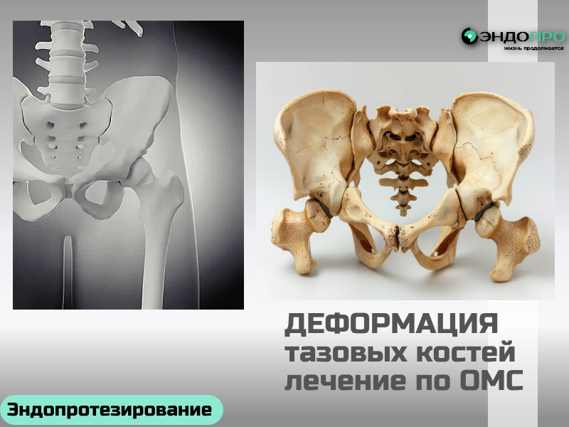 Деформация костей таза лечение по ОМС
Деформация костей таза — серьёзное состояние, требующее индивидуального подхода: тактика терапии всегда определяется причиной и степенью изменений.

На ранних стадиях и при функциональных нарушениях основу лечения составляют консервативные методы: лечебная физкультура для укрепления мышечного корсета и восстановления баланса, физиотерапия, мануальные техники и ортопедические средства. Такой комплекс помогает снизить нагрузку на таз, уменьшить болевой синдром и улучшить биомеханику движений.

При выраженных анатомических изменениях, последствиях травм или врождённых патологиях может потребоваться хирургическое вмешательство. Операции направлены на коррекцию положения костных структур и восстановление опорной функции таза — тактику подбирают с учётом данных КТ, МРТ и общего состояния пациента.

Ключевое условие эффективного лечения — точная диагностика и наблюдение у профильного специалиста: только врач может определить оптимальный путь коррекции и избежать осложнений.