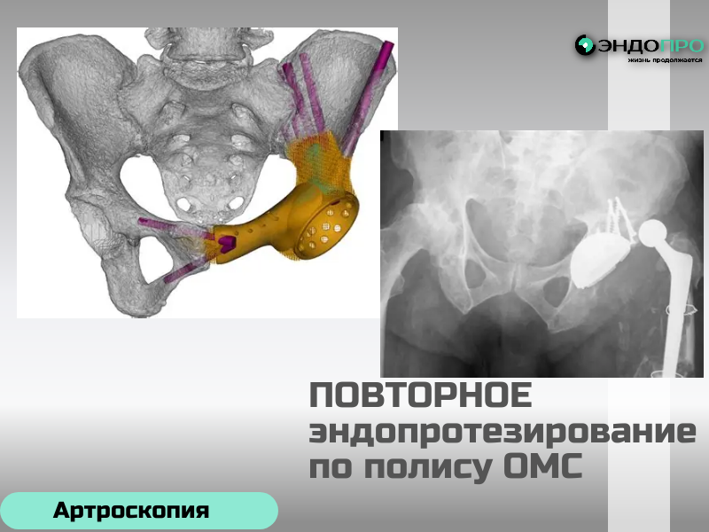 Ревизионное эндопротезирование опасно ли делать? (доступно по ОМС для граждан РФ) 
Ревизионное эндопротезирование — более сложная операция по сравнению с первичной заменой сустава, поэтому риски у неё выше. Хирургу приходится удалять старый имплант, работать с изменённой анатомией и нередко — с дефицитом костной ткани. Среди возможных осложнений — инфекции, переломы костей в зоне вмешательства, вывихи нового протеза, тромбоэмболические события.
При этом современные технологии (навигационные системы, роботизированная хирургия, улучшенные 