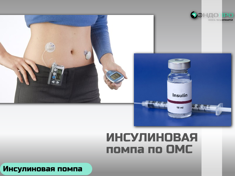 Стоит ли устанавливать инсулиновую помпу? БЕСПЛАТНО (ОТ 18 ЛЕТ)
Однозначного ответа нет — всё зависит от типа диабета, образа жизни и готовности активно участвовать в лечении. Но если коротко: помпа серьёзно улучшает качество жизни и контроль сахара, но требует дисциплины, затрат и обучения.
Кому помпа действительно помогает
Помпа имитирует работу здоровой поджелудочной железы: подаёт инсулин ультракороткого действия непрерывно малыми дозами (базальный режим) и дополнительно перед едой (болюсный). Это особенно полезно при: 
диабете 1 типа с нестабильным сахаром, частыми гипогликемиями или 