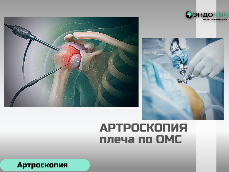 Артроскопия плеча как проходит операция? (бесплатно по полису ОМС)
Подготовка
Перед операцией пациент проходит обследование: анализы крови и мочи, ЭКГ, рентгенография или МРТ плеча, флюорография. Обязательна консультация анестезиолога — чаще всего применяется межлестничный блок с седацией или общий эндотрахеальный наркоз. 
Этапы операции
Позиционирование и анестезия. Пациента укладывают на бок или в положение полусидя, плечо обрабатывают антисептиком, конечность фиксируют. Выполняется выбранный вид обезболивания. 
Создание доступов. Хирург намечает точки проколов с учётом расположения сосудов и нервов, делает 2–4 портала (задний, передний, латеральный). Полость сустава заполняется стерильным раствором для расширения щели и улучшения обзора. 
Диагностический осмотр. Врач последовательно оценивает все внутрисуставные структуры на экране, уточняет локализацию и характер повреждений. 
Лечебный этап. В зависимости от патологии выполняются: сшивание разорванных сухожилий, рефиксация суставной губы якорными фиксаторами, субакромиальная декомпрессия, шейвинг, удаление свободных тел, санация или дебридмент. 
Завершение.