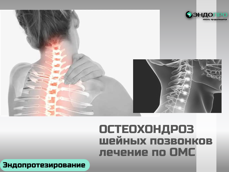 Стоит ли оперироваться при остеохондрозе шейных позвонков? по ОМС для граждан РФ
Хирургическое вмешательство оправдано, когда:

грыжа или остеофиты сдавливают спинной мозг, что проявляется слабостью в руках и ногах, нарушением походки, онемением;
корешковый синдром не поддаётся лечению и приводит к стойкой боли, потере чувствительности или атрофии мышц;
боль не снимается препаратами на протяжении месяцев и серьёзно снижает качество жизни;
на МРТ подтверждена компрессия нервных структур, которая прогрессирует.
Когда оперировать не стоит:
симптомы ограничиваются болью в шее без неврологического дефицита;
нет подтверждённого сдавления спинного мозга или корешков на снимках;
не пройден полноценный курс консервативного лечения;
есть противопоказания по общему здоровью.
Операция не «убирает остеохондроз» — она устраняет компрессию, снимая угрозу спинному мозгу и нервам. Дегенеративные изменения позвонков остаются, и без изменения привычек проблема может прогрессировать на других уровнях. Решение принимается неврологом и нейрохирургом на основе МРТ, неврологического осмотра и динамики заболевания.