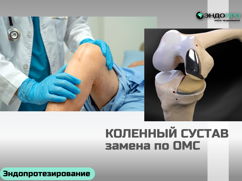 Замена коленного сустава на основе программы ОМС для граждан РФ Что покрывает полис ОМС В рамках программы государство полностью оплачивает: Как получить направление: пошагово Обратитесь к ортопеду-травматологу в поликлинике по месту прикрепления Пройдите обследования — рентген, МРТ, КТ, анализы крови и мочи по назначению врача. Получите заключение врачебной комиссии поликлиники о наличии показаний. Оформите направление по форме 057/у — на нём должны стоять подпись лечащего врача и печать медучреждения. Обратитесь в клинику, которая проводит эндопротезирование по ОМС, — с направлением и полным пакетом документов. саму операцию эндопротезирования; эндопротез — современный имплантат от сертифицированных производителей; пребывание в стационаре; базовые этапы