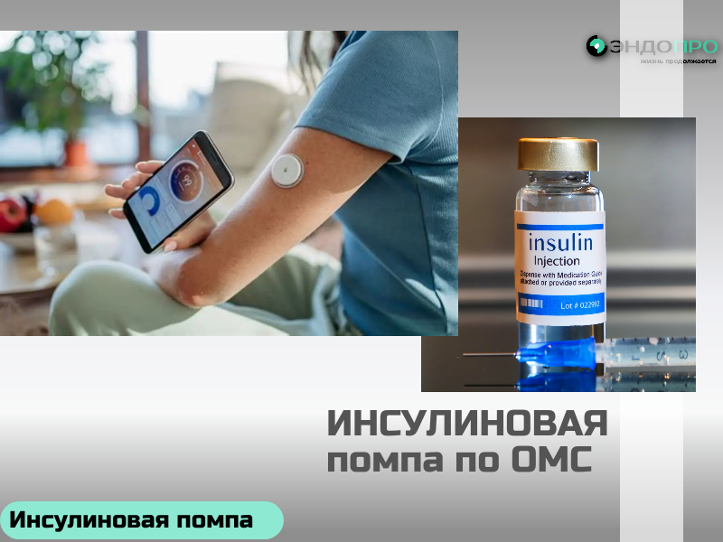Инсулиновая помпа Medtronic MiniMed 720G (по ОМС Бесплатно от 18 лет) Инсулиновая помпа Medtronic MiniMed 720G — современное решение для управления сахарным диабетом. Устройство непрерывно и точно подаёт инсулин, имитируя работу здоровой поджелудочной железы: обеспечивает базальную подачу и позволяет вводить болюсы для компенсации приёма пищи или коррекции уровня глюкозы. Ключевая особенность модели — интеграция с системой непрерывного мониторинга глюкозы (с сенсором Guardian Sensor 3 и трансмиттером Guardian Link 3). Технология SmartGuard заблаговременно предупреждает о риске гипо‑ или гипергликемии — за 30 минут до возможного отклонения, а при угрозе низкого сахара может