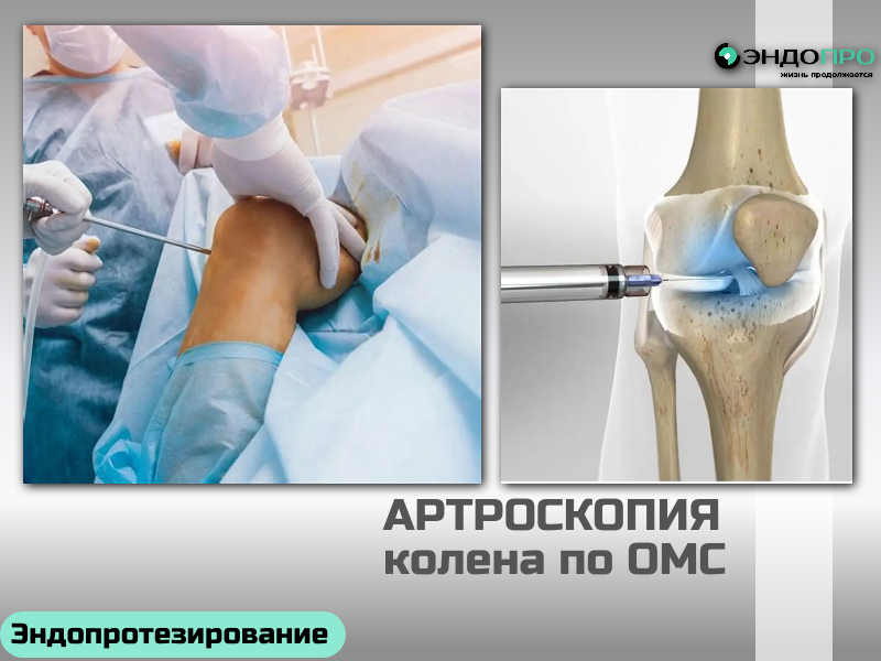 Опасна ли артроскопия коленного сустава? по ОМС для граждан России от 18 лет Какие риски возможны Инфекция. Риск невысок, но он есть. Проявляться может покраснением, отёком, усилением боли, выделениями из места прокола. Кровотечение. Внутрисуставное или подкожное кровоизлияние (гемартроз) — редкость благодаря минимальной инвазивности, но полностью исключить нельзя. Повреждение нервов или сосудов. Такое случается крайне редко, но в отдельных случаях может привести к временному или, в исключительных ситуациях, стойкому нарушению чувствительности или движений. Проблемы с анестезией. Как и при любой процедуре под наркозом, есть риск индивидуальной реакции — от аллергии до проблем с дыханием. Тромбоз глубоких вен. В отдельных случаях после операции может развиться тромбоз, особенно если у пациента есть факторы риска (например, нарушения свёртываемости крови, малоподвижность в восстановительном периоде). Другие осложнения. Иногда после процедуры пациенты отмечают усиление боли, отёк, временную жёсткость сустава. В редких случаях возможно формирование спаек или стойкое ограничение подвижности.