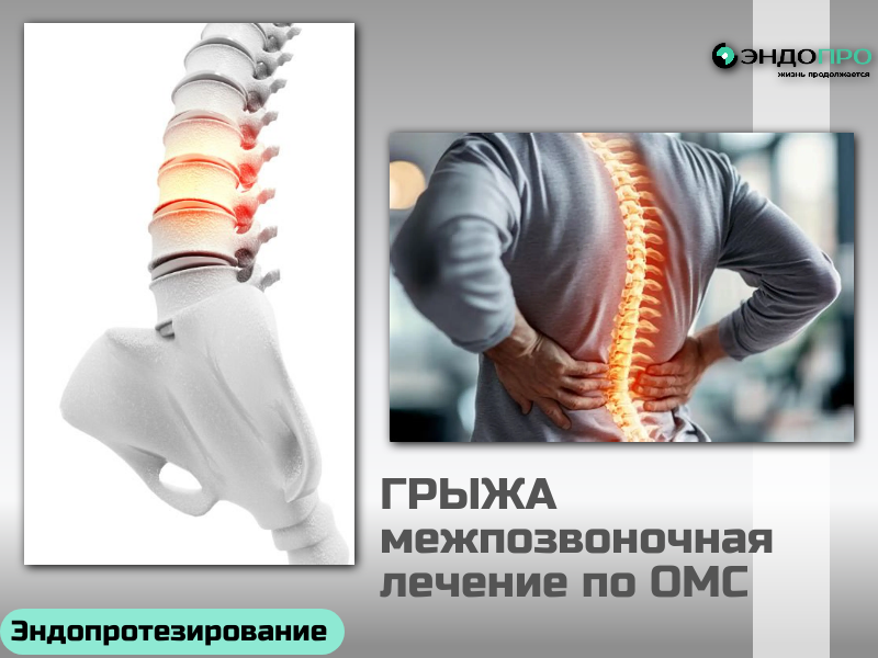 Какой врач лечит межпозвоночную грыжу? (для граждан РФ по ОМС) Лечением межпозвоночной грыжи занимается несколько специалистов — выбор зависит от стадии болезни и тактики терапии. Терапевт — первая точка входа: соберёт анамнез, проведёт первичный осмотр и направит к узкому специалисту. Невролог — основной врач при грыже: ставит диагноз, назначает консервативное лечение (медикаменты, ЛФК, физиотерапию), контролирует динамику. Вертебролог — узкий специалист по патологиям позвоночника: подбирает комплексную тактику с учётом особенностей дегенеративных изменений. Нейрохирург или травматолог‑ортопед — к ним обращаются, если консервативная терапия не помогает либо есть показания к операции (например, выраженная компрессия нервов, нарастающая слабость в конечностях). Оптимальный старт — приём у терапевта или невролога: после осмотра и МРТ врач