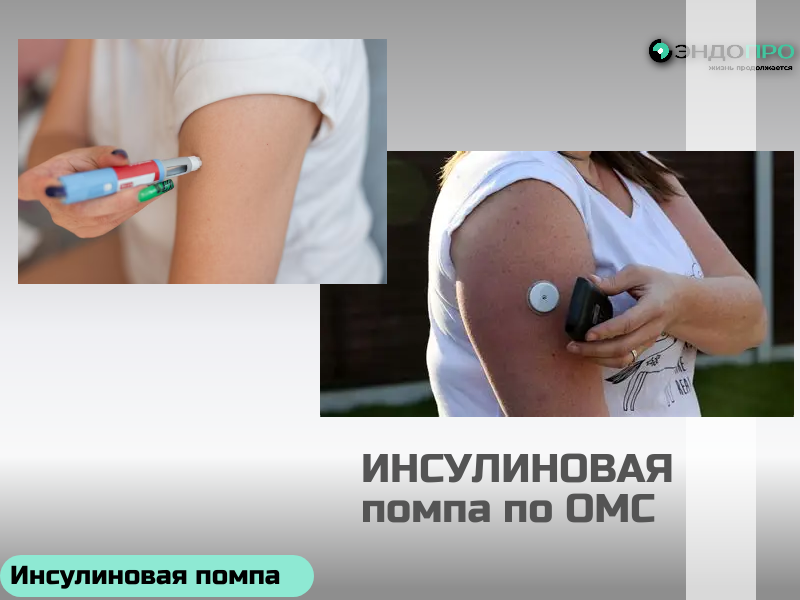 Стоит ли переходить на инсулиновую помпу? Для граждан РФ по ОМС Переход на инсулиновую помпу оправдан, если текущая схема инъекций не даёт стабильного контроля сахара. Помпа имитирует работу поджелудочной железы — подаёт инсулин короткого действия непрерывно малыми дозами и позволяет вводить болюсы перед едой. Это снижает риск гипогликемий, уменьшает колебания глюкозы и даёт гибкость при спорте и нестабильном режиме дня. Точность дозирования (до 0,025 ЕД) особенно важна для детей и пациентов с лабильным диабетом 1 типа. Но помпа — не автоматическое решение. Она требует дисциплины: регулярного мониторинга сахара, подсчёта углеводов, замены расходников каждые 3 дня и постоянного контроля за работой системы. Поскольку в помпе используется только инсулин короткого действия, любая остановка подачи (перегиб трубки, сбой) может привести к кетоацидозу за считанные часы. Стоимость устройства и расходных материалов выше, чем у шприц-ручек, а носить прибор придётся круглосуточно. Помпа полезна, если: сахар нестабилен, частые гипо, планируется беременность, нужен гибкий режим дня. Может не оправдать себя, если: текущая схема уже даёт хороший результат без тяжёлых эпизодов, а мотивация к постоянному самоконтролю невысока. Решение стоит
