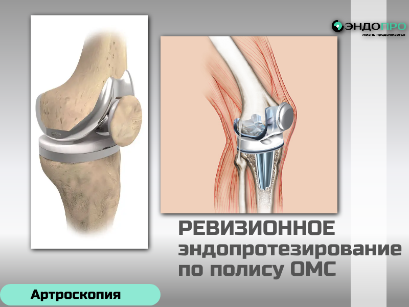 Ревизионное эндопротезирование в чем сложность операции? доступно по ОМС для граждан РФ Ревизионное эндопротезирование — это повторная замена уже установленного искусственного сустава. Считается технически самой сложной операцией в ортопедии. Вот почему. Удаление старого протеза Хирургу нужно извлечь прежний имплант, часто намертво вросший в кость. Процесс трудоёмкий: металл и цемент приходится аккуратно выпиливать, высверливать и отделять от костной ткани, не повредив её ещё больше. На этом этапе высок риск перелома кости и кровопотери. Дефицит костной ткани Когда протез извлечён, хирург видит, что кость вокруг него истончилась или разрушена — это закономерное следствие износа импланта и расшатывания. Восстановить костную опору для нового протеза — ключевая задача, и она решается костными трансплантатами (собственными или донорскими), специальными кольцами, сетками, аугментами и усиленными ревизионными конструкциями. Изменённая анатомия и рубцы После первой операции анатомические ориентиры смещены, ткани зарубцеваны, связочный аппарат часто ослаблен или повреждён. Хирург работает не с «чистой» зоной, а с изменёнными структурами, где нет универсальных решений — каждый случай планируется индивидуально