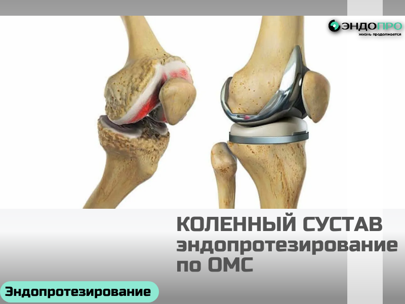 Какой процент осложнений после эндопротезирования коленного сустава? По ОМС для граждан РФ
В среднем серьёзные осложнения после эндопротезирования коленного сустава возникают примерно в 1–2% случаев. 
Но важно понимать: эта цифра сильно зависит от многих факторов — опыта хирурга, состояния здоровья пациента до операции (наличие диабета, ожирения, хронических инфекций), а также от того, насколько строго соблюдались протоколы профилактики (антибиотикопрофилактика, тромбопрофилактика, ранняя активизация). 
Среди возможных проблем — инфицирование области операции, тромбоз глубоких вен, а в отдалённом периоде — асептическое расшатывание компонентов протеза или развитие контрактуры. При этом большинство рисков можно минимизировать, а при своевременном выявлении и лечении осложнения успешно купируются. 
Поэтому перед операцией врач подробно обсуждает индивидуальные риски и составляет план их профилактики — это самый 