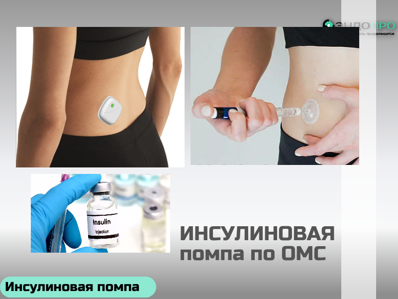 Инсулиновая помпа Medtronic MiniMed 720G (по ОМС Бесплатно от 18 лет)
Инсулиновая помпа Medtronic MiniMed 720G — современное решение для управления сахарным диабетом. Устройство непрерывно и точно подаёт инсулин, имитируя работу здоровой поджелудочной железы: обеспечивает базальную подачу и позволяет вводить болюсы для компенсации приёма пищи или коррекции уровня глюкозы.
Ключевая особенность модели — интеграция с системой непрерывного мониторинга глюкозы (с сенсором Guardian Sensor 3 и трансмиттером Guardian Link 3). Технология SmartGuard заблаговременно предупреждает о риске гипо‑ или гипергликемии — за 30 минут до возможного отклонения, а при угрозе низкого сахара может автоматически приостановить подачу инсулина.
Компактный корпус (96 × 53,6 × 24,4 мм) и вес всего 106 г делают помпу удобной для повседневного ношения. Минимальный шаг дозирования — 0,025 ЕД — позволяет гибко настраивать терапию. Данные можно отслеживать в приложении MiniMed Mobile, а для врачей и близких доступна функция удалённого мониторинга через CareLink Connect.