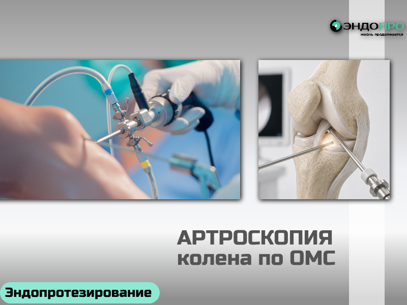 Артроскопия коленного сустава под наркозом или нет? по ОМС для граждан России от 18 лет Да, при артроскопии коленного сустава обезболивание обязательно, но какой именно метод выберут, решает врач индивидуально. Я коротко поясню варианты: иногда достаточно местной анестезии (для очень коротких диагностических манипуляций), чаще применяют спинальную (вы остаётесь в сознании, но не чувствуете