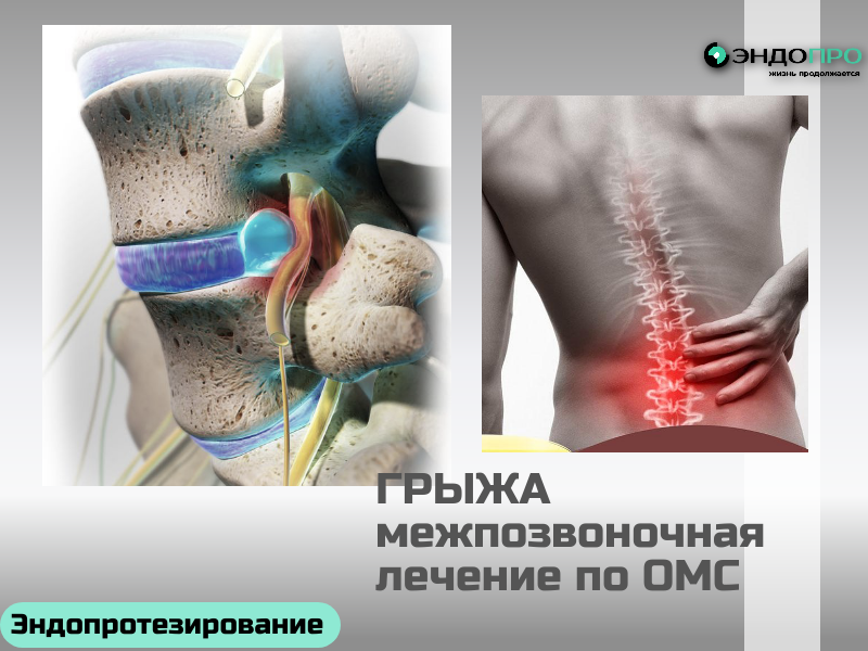 Со скольки лет удаляют межпозвоночную грыжу? (для граждан РФ по ОМС)
Чёткого возрастного порога для удаления межпозвоночной грыжи не существует — решение принимают не по возрасту, а по клинической картине. Операцию могут провести и подростку (обычно начиная с 14–16 лет), если грыжа вызывает серьёзные проблемы: стойкий болевой синдром, не поддающийся консервативному лечению, нарастающий неврологический дефицит (слабость в конечностях, онемение, нарушение функции тазовых органов).
У детей и подростков грыжи встречаются редко, но при травмах, диспластических изменениях позвоночника или интенсивных спортивных нагрузках они возможны. В таких случаях хирурги стараются применять максимально щадящие методики — прежде всего микрохирургическое удаление через небольшой разрез, чтобы минимально затронуть структуры позвоночника.
Сначала всегда пробуют консервативное лечение (ЛФК, медикаменты, физиотерапия, блокады), и только если за несколько месяцев оно не приносит результата либо появляются «красные флаги», 